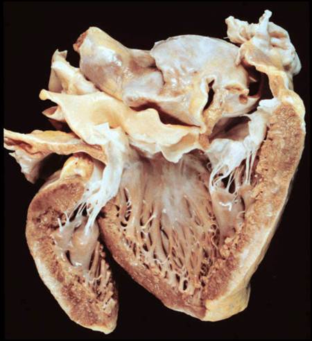 Efectos esteroides corazon